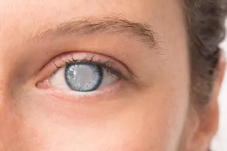 Early cataract