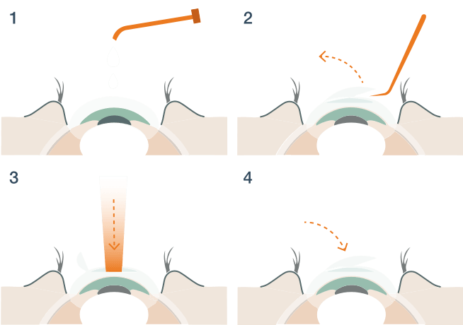 Femto Lasik (3)