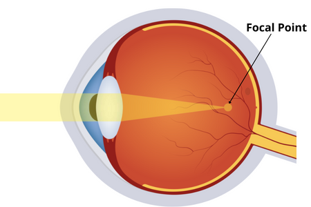 Myopia_vision