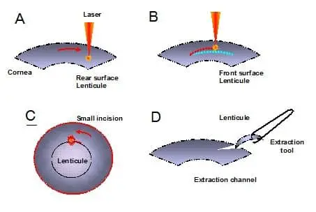 Smile eye procedure