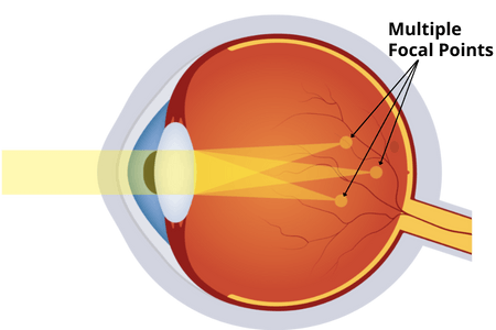 astigmatism_vision_lasik
