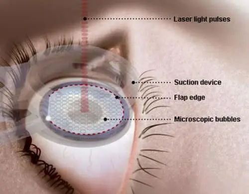 standard_lasik