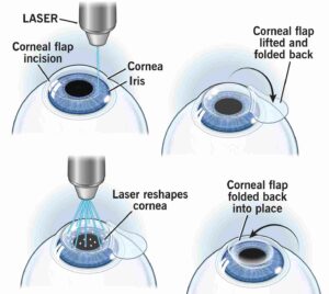 Blurred Vision After Lasik: How It Feels, Causes And Tips To Manage