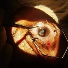 Cataract Surgery