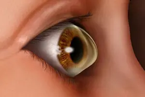 What Is Keratoconus?