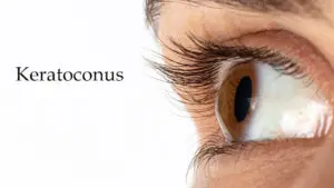 Keratoconus Lasik Procedure