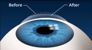 What Is Myopia Correction Surgery?