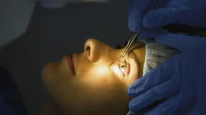 Myopia Correction Surgery