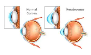 Risks And Complications Of Keratoconus Lasik