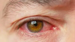 Side-Effects of Contoura Surgery