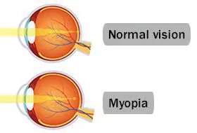 Defining Myopia