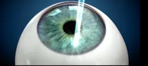 Is iLasik The Same As Lasik?