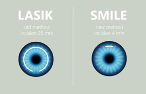 What Is SMILE Laser Eye Surgery?