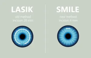 What Is SMILE Laser Eye Surgery?