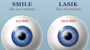 Is SMILE The Same As Lasik?