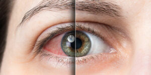 What Are the Symptoms of Dry Eyes After Lasik?