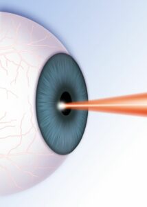 Who Can Consider Lasik Surgery?
