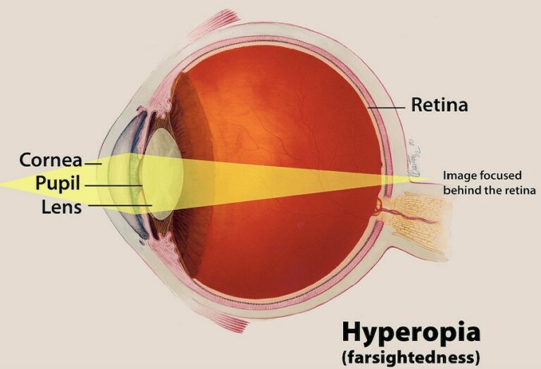 Farsightedness Hyperopia: Meaning, Causes, Diagnosis, Treatment