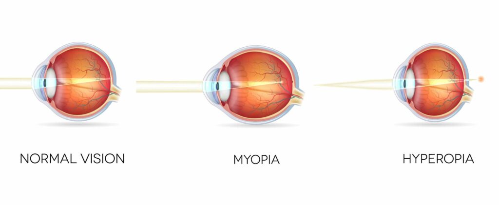 Farsightedness Hyperopia: Meaning, Causes, Diagnosis, Treatment