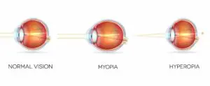 Is Hyperopia Farsightedness Or Nearsightedness?