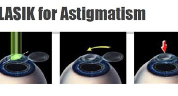 दृष्टिवैषम्य के लिए लेसिक: फायदे और सीमाएं – Lasik For Astigmatism: Benefits And Limitations In Hindi