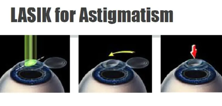 दृष्टिवैषम्य के लिए लेसिक: फायदे और सीमाएं – Lasik For Astigmatism: Benefits And Limitations In Hindi