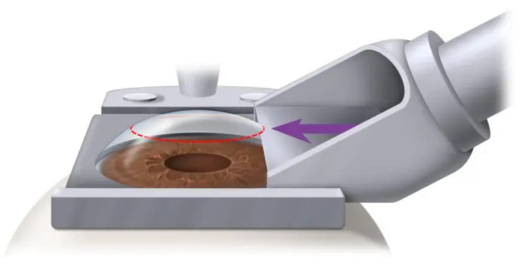 माइक्रोकेराटोम लेसिक: फायदे और नुकसान – Microkeratome Lasik: Benefits And Disadvantages In Hindi