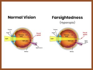 Farsightedness (Hyperopia): What It Is and How to Treat It