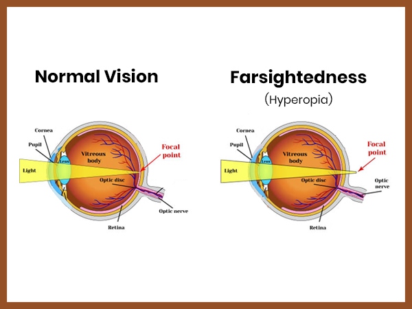 Farsightedness Hyperopia: Meaning, Causes, Diagnosis, Treatment
