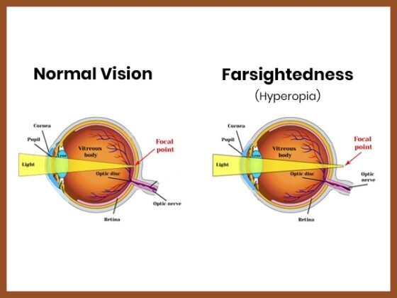 Hyperopia Vision