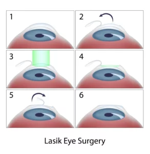 What Are The Types of Lasik Surgery?