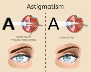 Is Lasik For Astigmatism Effective?