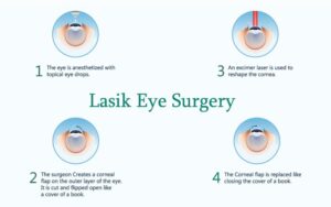 What Is Lasik Surgery?