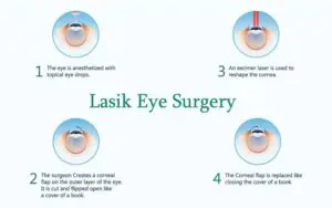 What Is Lasik Surgery?