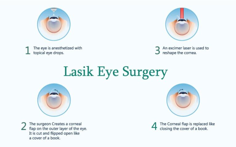 lasik-surgery-age-limit-age-and-recommendations-other-criteria