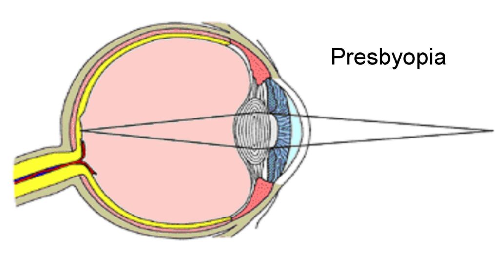 Causes of Presbyopia