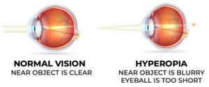 What is Hyperopia (Farsightedness)?