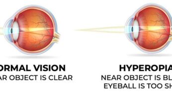 Hyperopia Farsightedness- Everything You Need To Know About