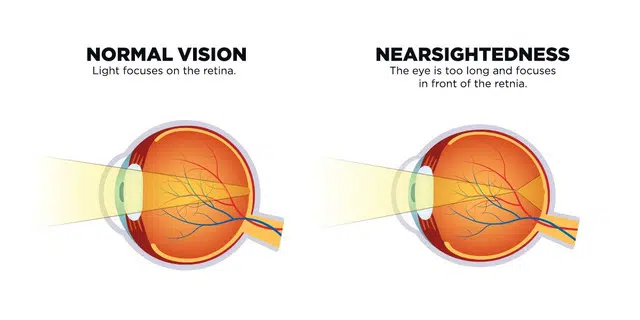 निकट दृष्टिदोष के लिए लेसिक: फायदे और जोखिम – LASIK For Nearsightedness: Benefits And Risks In Hindi