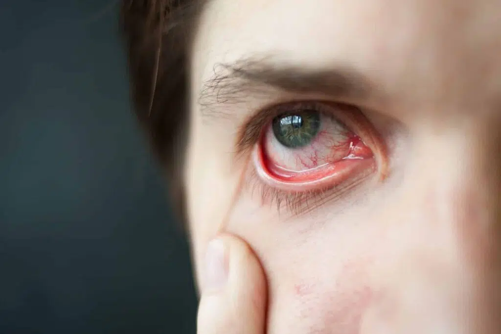 Symptoms of Presbyopia