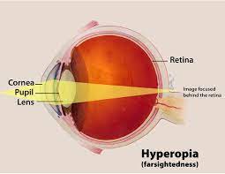 What Is Hyperopia-farsightedness?