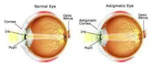 What Is Astigmatism?