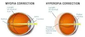 What Is Hyperopic Lasik?