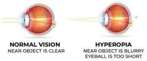 What Is The Procedure Of Hyperopic Lasik?