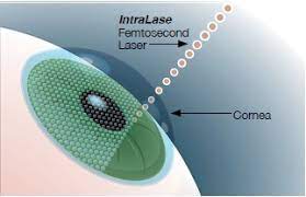 What Is Intralase Lasik?