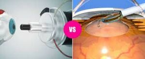 Is IOL Better Than Lasik?