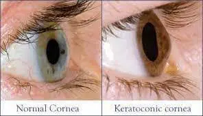 What Is Thin Cornea Lasik?