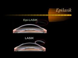 How EPI Lasik Works?