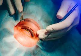 What Is The Procedure Of Intralase Lasik?
