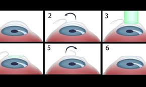 What Is Refractive Surgery?